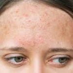 food allergies and acne
