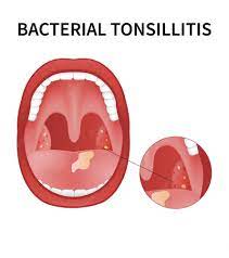 are tonsil stones related to allergies