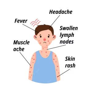 seasonal allergies swollen lymph nodes