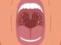 can allergies cause tonsil stones