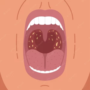 can allergies cause tonsil stones